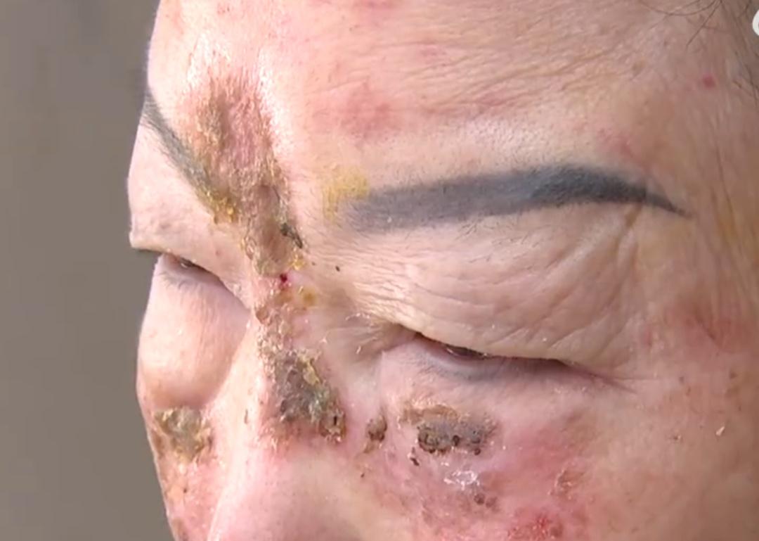在萧山蓝奥医疗美容花2万多想变美遭毁容 73岁老人彻夜难眠(图3)